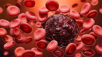 expert-blood-cancer-treatment