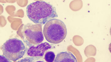 myelodysplastic-syndromes