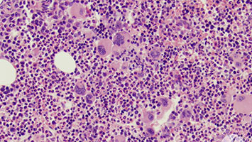 myeloproliferative-neoplasms